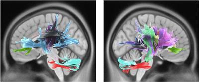 Sex Differences are Reflected in Microstructural White Matter Alterations of Musical Sophistication: A Diffusion MRI Study